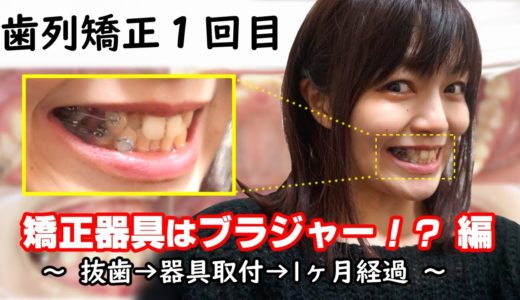 【歯列矯正一か月目】痛み/違和感/食事について語りつくす【抜歯～装着】改訂版