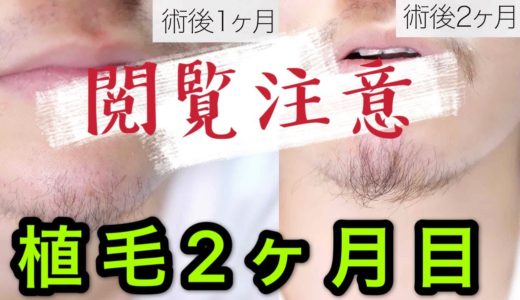 【閲覧注意】植毛をして2ヶ月経過したからレポートしていく！