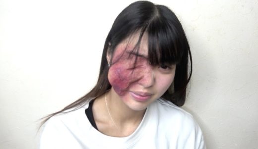 妹が顔の病気。もう限界無理。逃げ出したい