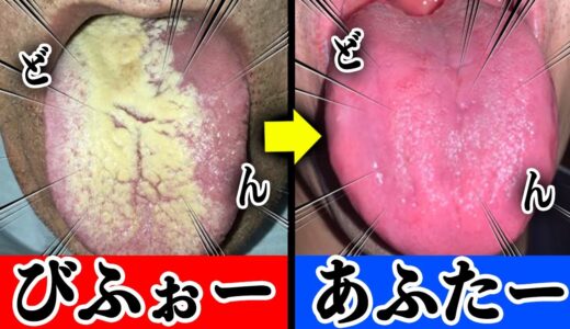 「アンタの口は臭いんや！」そう言われない為に秒で舌がエグい綺麗になるひみつ道具を　歯医者かおりが紹介します
