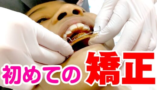 【はじめての矯正】歯並び治したい！痛い？怖い？大きさは？★矯正後の素直な感想…「歯が動いてるみたい」