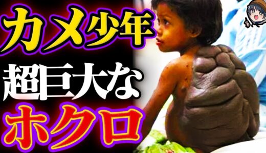 【衝撃】背中に『超巨大ほくろ』がある男の子