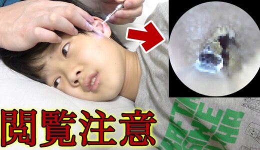 【閲覧注意】1ヶ月耳掃除してない耳の中をカメラ付き耳かきで見たら汚すぎてゴッソリ取れまくり！耳垢王は誰！？【耳垢を掃除】