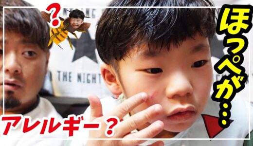 【ご報告】息子のほっぺの傷について…。原因はアレルギー？虫刺され？🐝💦【育児日記】