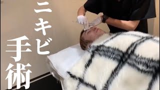 ニキビ手術する。